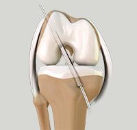 ACL Reconstruction