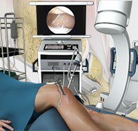 Arthroscopic Reconstruction of the Knee for Ligament Injuries