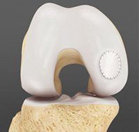 Cartilage and Meniscus Repair