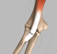 Distal Biceps Tendon Repair