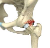 Femoroacetabular Impingement