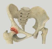 Hip Arthritis