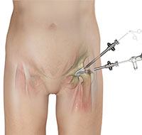 Hip Arthroscopy