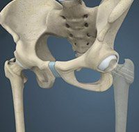 Hip Fracture