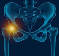 Hip Pain