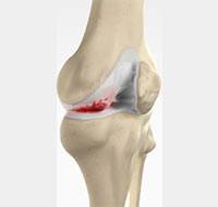 knee-arthritis