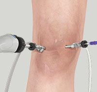 Knee Arthroscopy