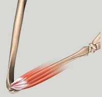 Lateral Epicondylitis (Tennis Elbow) Surgery