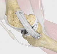 MCL Reconstruction