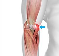Medial Epicondylitis (Golfer's Elbow) Surgery