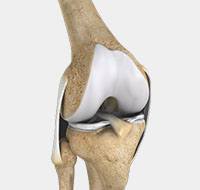 Multiligament Knee Injury