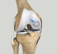 Osteochondritis Dissecans