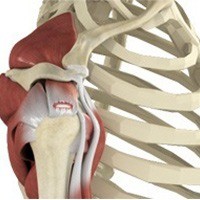 Rotator Cuff Tear