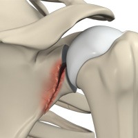 Shoulder Fracture