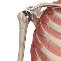 Total Shoulder Replacement