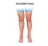 Unstable Knee